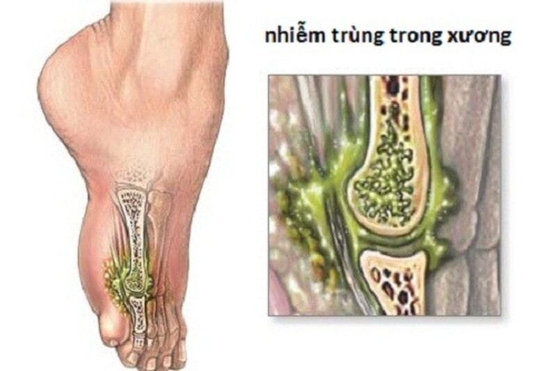 nguyên nhân đau nhức xương khớp chân