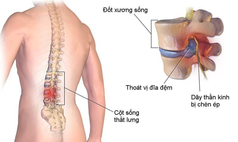 đau nhức lưng dưới bên trái